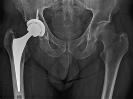 Total-hip-arthroplasty