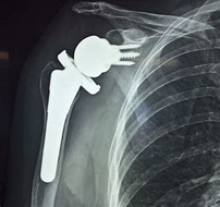 replacement surgery replacement-surgery